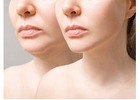 Can Surgery Transform Your Facial Features Naturally?